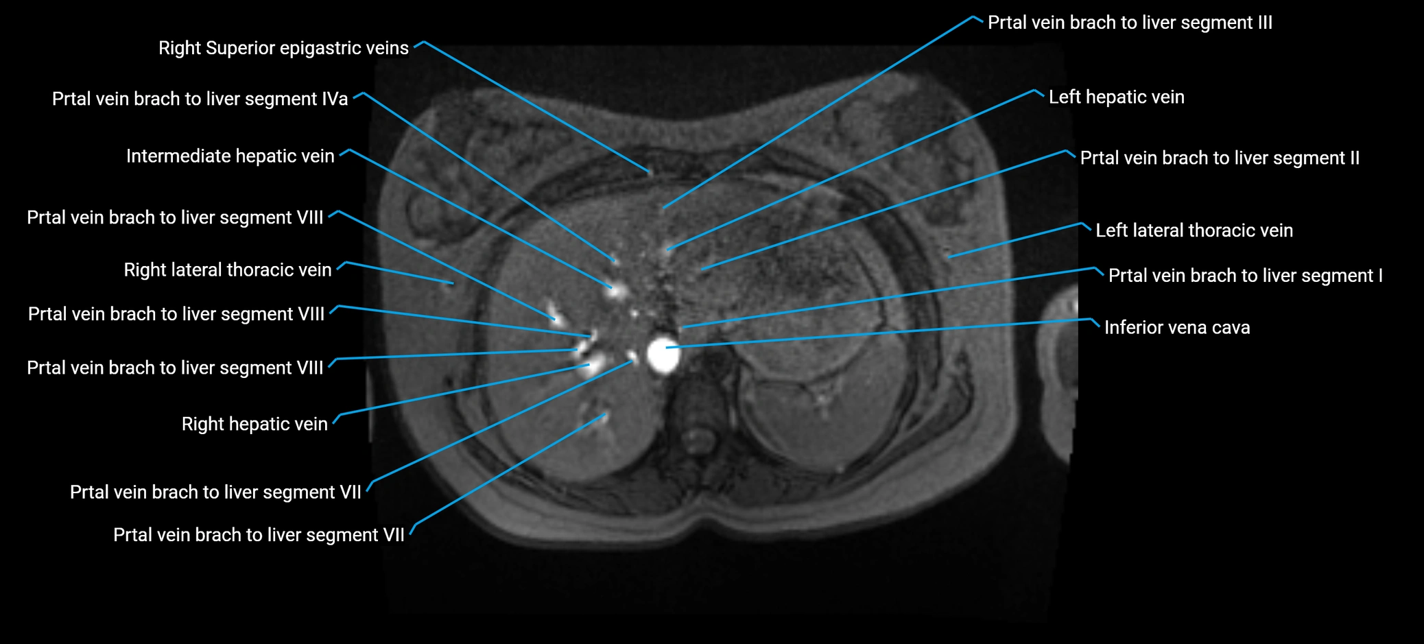 MRV abdomen pelvis & lower limb axial cross sectional anatomy labelled MRI image 31 (1).webp